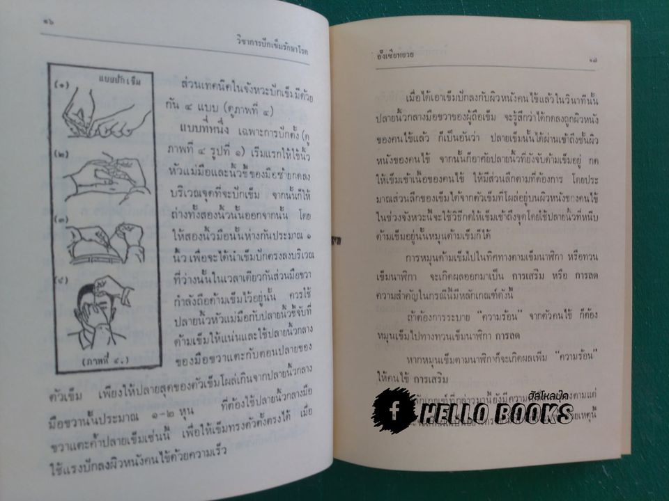 วิชาการปักเข็มรักษาโรค ภาคปฏิบัติเบื้องต้น